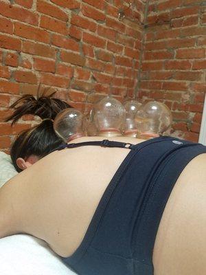 Cupping session for upper back pain and stress