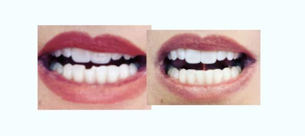 Lower front chipped tooth repaired with bonded filling-  Easy and beautiful!