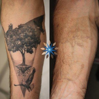 Laser Tattoo Removal