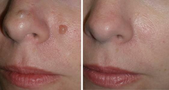 Before and after of mole removal with radiofrequency.