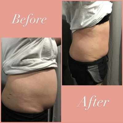 Non Invasive Body Contouring