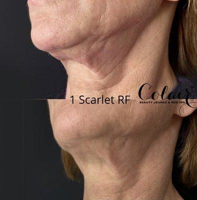 Scarlet RF Microneedling for skin tightening