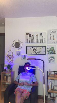 Teeth whitening treatment