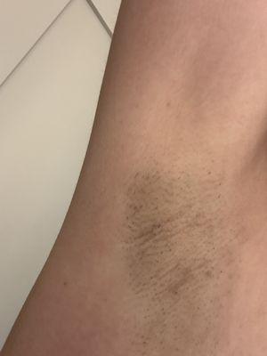 Underarm after wax appointment