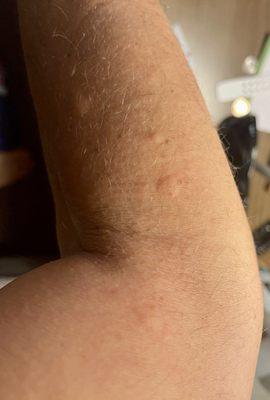 These are the bumps that the bedbug left on my arm.