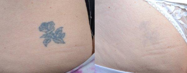 This patient is happy to finally get rid of her tattoo.