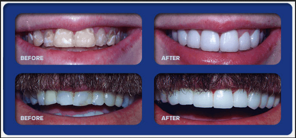 Before & Afters Dental Procedure