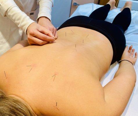 Acupuncture- decreases pain, anxiety, headaches, GI issues, autoimmune symptoms and more!