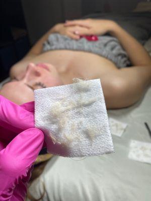 Dermaplaning