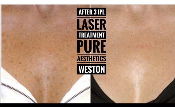 Ipl photofacial treatment for pigmentation removal!