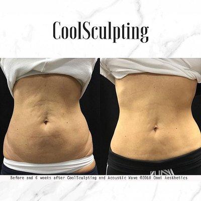 6 weeks! CoolSculpting before and after results. A non-surgical procedure with little to no downtime!