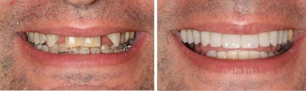 Smile Makeover