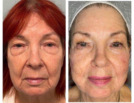 NO Surgical Face Lift NEEDED! She got "IDENTIFIED" PDO THREAD, DERMAL FILLER & NEUROTOXIN Combo treatment. FLAWLESS! INSTANT RESULTS