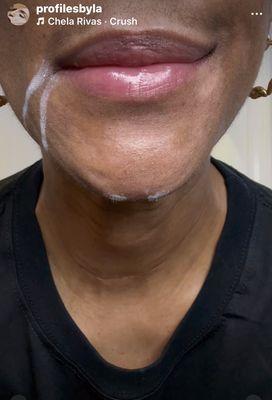 Lip assymetry (downturned mouth on the right side of face) Marking shows DAO muscle being prepped for neurotoxin injection.