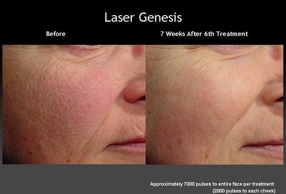 Laser Genesis™ helps to reduce the appearance of fine lines and wrinkles, and even out skin tone.