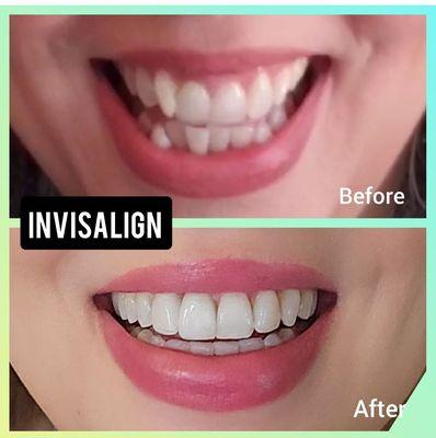 Dr. Ruggeroli did my Invisalign. I'm thrilled with the process and the results.