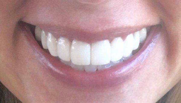 Porcelain crowns on my top teeth by Anthony Dillard DDS