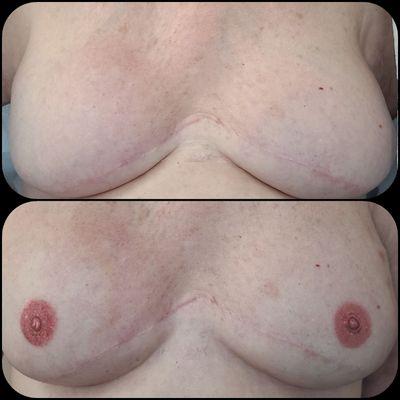 POSTMASTECTOMY AREOLA ARTISTRY 
MEDICAL TATTOO