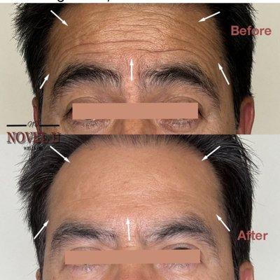 Frontalis line correction with Neuromodulator