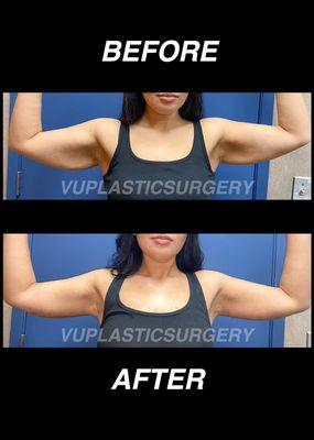 Brachioplasty- post 1 month