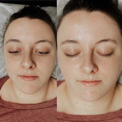 Before and after microdermabrasion treatment and enzyme mask.