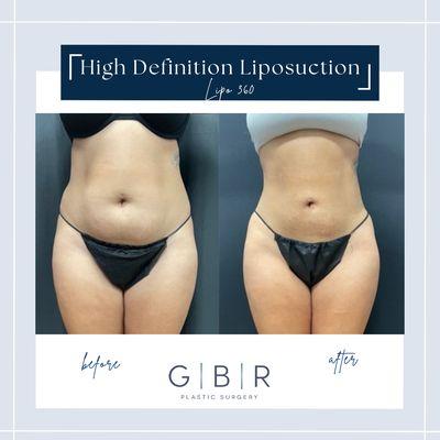 Liposuction Virginia beach