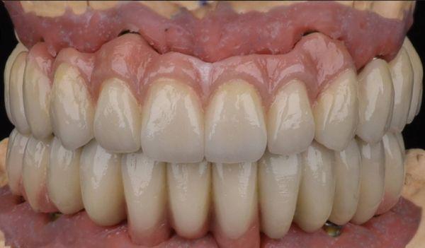 Upper and lower full mouth reconstruction. Dr Bruce Vafa