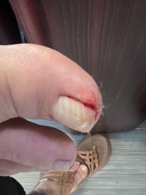 Cut that happened during pedicure