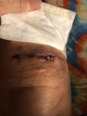 Incision of reconstructed ACL surgery