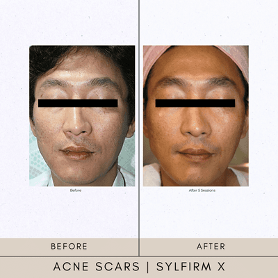 Acne Scars Sylfirm x