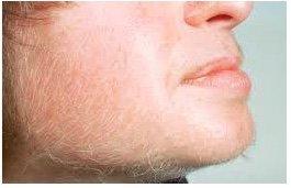 Removal of Peach fuzz, blonde or dark - any color all over face