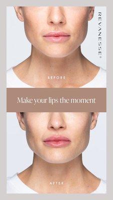 Versa plus lips filled before and after