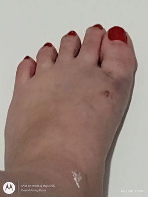 Up close picture of fractured left big toe and foot