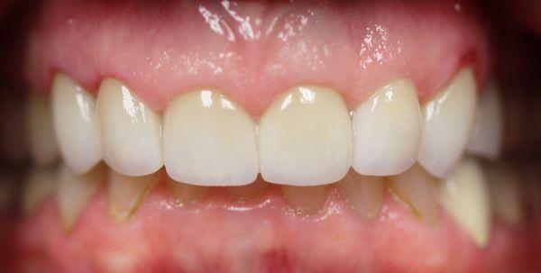 Patient 1: After Cosmetic Porcelain Crowns