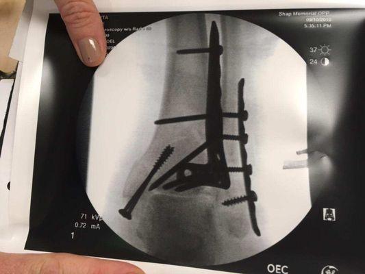 Post surgery - xray of my plafond fracture - wolverine style