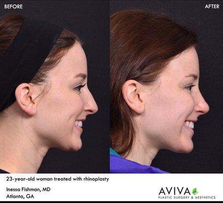 Rhinoplasty or nose surgery is a permanent way to reshape the nose.