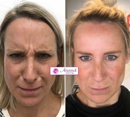 Botox for Frown Lines