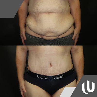 United Plastic Surgery | Tummy Tuck