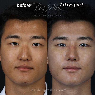 Rhinoplasty, 7 days post.