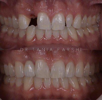 Implant and veneer case