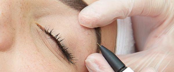 Eyebrow Electrolysis