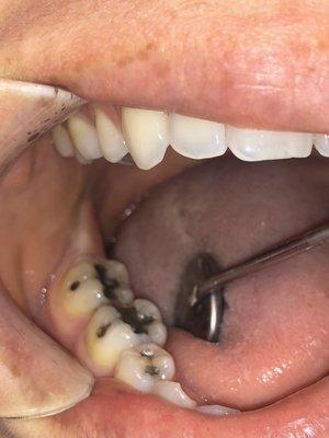 Before (metal fillings) Broken Tooth - by Dr. Gary Gwilt