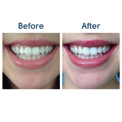 Professional Teeth Whitening