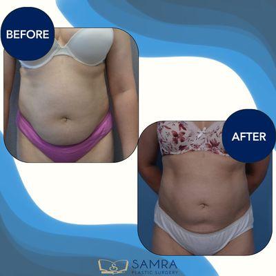 Liposuction can help eliminate stubborn fat that diet & exercise can't seem to touch.