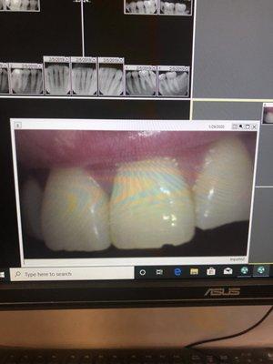 Chipped tooth