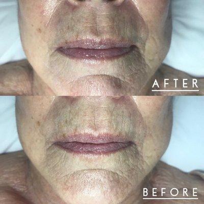 Anti-aging Facial