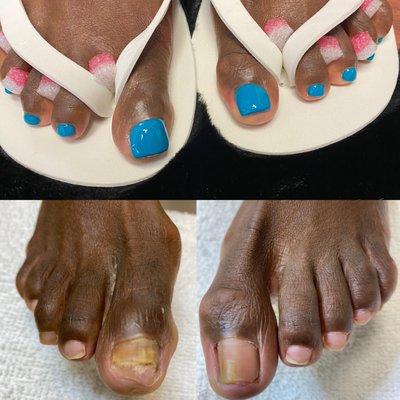 Toenail Restoration