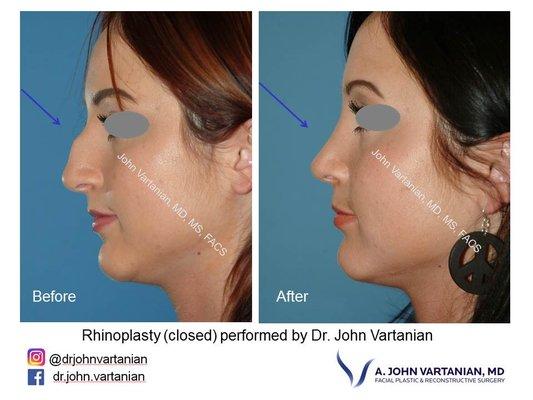 Before and after closed rhinoplasty by Dr. John Vartanian.