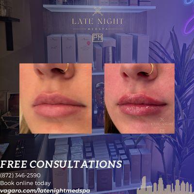 Natural restoration lip filler