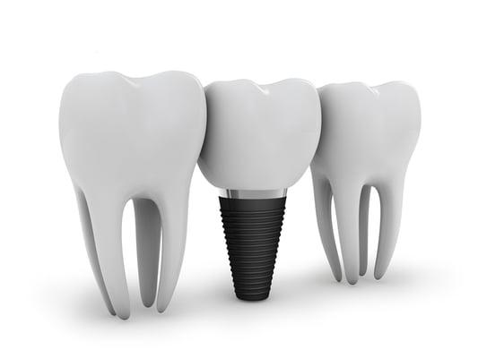 if you are missing a single tooth or several teeth dental implants may be the answer